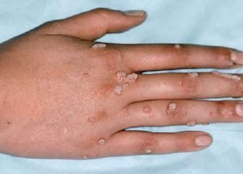 بعد كورونا جدري القردة  يضرب أوروبا