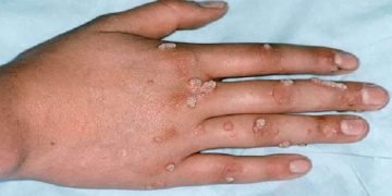 بعد كورونا جدري القردة  يضرب أوروبا