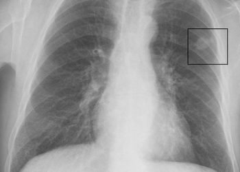 بعد وفاة هشام سليم بسرطان الرئة القومى للأورام يحذر المصريين
