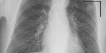 بعد وفاة هشام سليم بسرطان الرئة القومى للأورام يحذر المصريين